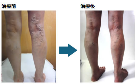 下肢静脈瘤の痛み｜ドクターが推薦する専門医療機関